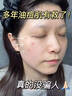 LA美國祛痘藥膏淡化痘印去痘痘和痘印痘坑修復(fù)女男士壬二酸青春學(xué)生 曬單實(shí)拍圖