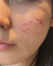 維特絲壬二酸祛痘藥膏煙酰胺凝膠去痘痘粉刺閉口男女水楊酸收毛孔青少年 曬單實(shí)拍圖