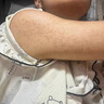 克林霉素甲硝唑搽劑 手臂毛囊炎專用特癢效藥 手臂毛囊炎長痘痘胳膊上的小疙瘩有黑點(diǎn)堵塞藥皮膚用藥 3盒裝【手臂毛囊炎】亦可用于全身 曬單實(shí)拍圖