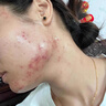 HIEUAILR水楊酸祛痘搭藥膏祛痘印疤淡化痘印痘坑修凹洞壬二酸消炎痤瘡專用 【極速凈痘】一盒見效裝 50g 曬單實(shí)拍圖