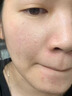 醫用精華液械字號收縮毛孔粗大修復細致去黑頭粉刺閉口男士女士祛痘印黑色素沉淀控油淡化痘印痘坑透明質(zhì)酸鈉 曬單實(shí)拍圖