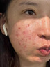 廣德堂新膚滿螨靈霜祛痘膏淡化痘印平痘坑男女生改善粉刺閉口紅腫痘面霜 廣德堂新芙滿靈祛痘霜20g 曬單實拍圖
