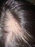 蔓迪米諾地爾酊 5%濃度米諾地爾酊嚴重脫發(fā)蔓迪生發(fā)噴霧育發(fā)液防脫發(fā)斑禿米諾地爾5%男士專(zhuān)用治脫發(fā)防脫固發(fā) 2瓶90ml【男士90天療程裝 咨詢(xún)客服領(lǐng)福利】 曬單實(shí)拍圖