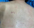 阿昔洛韋乳膏凝膠軟 帶狀皰疹后遺癥神經(jīng)痛用藥斷貨根 蛇盤(pán)瘡生殖器皰疹也可用抗病毒軟膏【視覺(jué)特效】 1盒【建議多盒使用】 曬單實(shí)拍圖