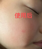 澀岡日本醫(yī)用生長(zhǎng)因子修復(fù)凝膠重組人表皮去黑色素沉淀祛痘印去疤痕 曬單實(shí)拍圖