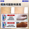 香港大藥房有限公司疣清寧扁平疣絲狀疣瘊子專用脖子上的去除小肉粒疙瘩一抹靈非藥膏 曬單實拍圖
