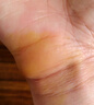 霍悉醫(yī)生腱鞘炎手腕腱鞘炎凝膠手指大拇指鼠標(biāo)囊腫鼓包網(wǎng)球肘專用非膏藥貼 曬單實(shí)拍圖