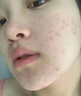 SUMDOY日本進口面膜亮白淡紋淡斑保濕補水緊致抗皺提亮膚色控油祛痘痘印 【體驗裝】控油祛痘一盒*5片 曬單實拍圖