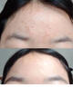 OHBT祛痘膏60g青春痘閉孔粉刺收縮毛孔專用學(xué)生男女凝膠男士化妝品 曬單實拍圖