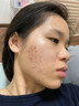 南京同仁堂祛痘膏去痘痘和痘印痘坑修復男女士改善粉刺閉口30g 曬單實拍圖
