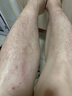 廬太醫(yī)天氣熱皮膚瘙癢腿癢小腿皮膚癢身上起紅疙瘩長紅點(diǎn)皮膚干燥癢炎 一盒裝 曬單實(shí)拍圖