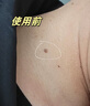 歐泉琳點(diǎn)痣筆去斑神器家用美容院專用小白掃斑疣子猴子肉粒專用筆扁平疣儀器激光神器 金色點(diǎn)痣筆 （送修護(hù)凝膠*1） 曬單實(shí)拍圖