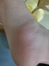 HERZFELD德國腳氣噴霧止癢脫皮爛腳丫真菌感染跟治噴劑狼毒腳臭腳出汗藥根 二盒【中度腳氣100%特專用效治】 曬單實拍圖