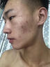 YYTISS祛痘淡化痘印去痘痘和痘印黑色素沉淀痘坑修疤復(fù)青春痘祛痘膏學(xué)生 曬單實(shí)拍圖