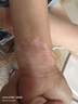 邦臣（BANGCHEN）308白癜風治療儀光療儀醫(yī)院紫外線燈同款銀屑病白斑窄譜nbuvb激光 【強度35/面積8】UV308D1標準款 曬單實拍圖