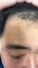 愛美熊醫(yī)用皮膚滾針生發(fā)米諾上藥微針滾輪頭皮按摩器刺激毛囊0.25 0.5mm 醫(yī)用0.25mm滾針【基本無痛】適合新手頭皮敏感 科學(xué)育發(fā)【脂溢性脫發(fā)/斑禿】專業(yè)在線咨詢探討 曬單實拍圖