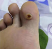 雞眼去除(發(fā)貨特效率)專(zhuān)用藥雞眼膏去看看根肉刺刺猴藥膏無(wú)痛脫落連根藥拔跖疣專(zhuān)用藥老繭水楊酸苯酚貼膏 1盒【皮膚增厚輕微疼痛】水楊酸i軟膏50%去雞眼 曬單實(shí)拍圖