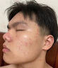 泊紫汀蘭祛痘膏祛痘淡化痘印消閉口修護痘痕痘坑去粉刺控油青春痘男女學(xué)生 曬單實(shí)拍圖