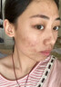 南京同仁堂祛痘膏去痘痘和痘印痘坑修復(fù)男女士改善粉刺閉口30g 曬單實(shí)拍圖