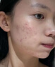 維特絲祛痘藥膏50g壬二酸水楊酸去痘痘和收毛孔閉口粉刺男女精華 曬單實(shí)拍圖