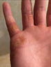 頤博士維e尿素霜止身上癢軟膏ve皮膚瘙癢干燥掉皮身上大腿內側癢 1支[體驗裝]無(wú)滿(mǎn)送 曬單實(shí)拍圖
