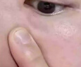 去除眼周白色顆粒脂肪粒去膏油脂粒眼睛脂肪粒汗管瘤小丘疹眼霜L 買二送一 曬單實拍圖