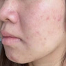 維特絲祛痘藥膏50g壬二酸水楊酸去痘痘和收毛孔閉口粉刺男女精華 曬單實拍圖