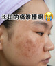焦博士日本377祛斑霜美白淡化老年黃褐雀斑黑色素熊果苷乳膏去曬男女士 曬單實(shí)拍圖