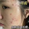 維特絲祛痘藥膏50g壬二酸水楊酸去痘痘和收毛孔閉口粉刺男女精華 曬單實拍圖