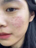 白樺依然祛痘膏美白去痘痘和痘印修復初高中生男女學生閉口粉刺青春痘30g 2瓶優(yōu)惠裝【立省10】 曬單實拍圖