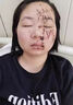 泰國鱷魚油去疤痕修復(fù)凝膠醫(yī)院專用去疤膏疤痕增生凸起去除疙瘩手術(shù)縫針修復(fù) 單盒裝 泰國祛疤修復(fù)愈合傷口 曬單實拍圖