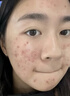 安伊妮青少年凈痘精華乳女控油修護(hù)舒緩保濕祛痘膏快速消紅腫痘印小白管 曬單實(shí)拍圖