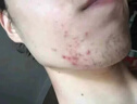 YZKMSKIN洗面奶控油祛痘除螨蟲去黑頭祛痘消炎痤瘡專用青少年成年清潔毛孔 控油祛痘洗面奶） 110ml 【單瓶裝 曬單實拍圖