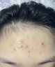 冰菊青少年祛痘面膜補水保濕滋潤青春期男女士學(xué)生專用茶樹祛痘面膜 茶樹面膜*50片散裝【店長推薦】 曬單實拍圖