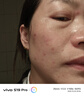 華美科 HURMEVKOR壬二酸凝膠20%醫壬二酸凝膠祛痘凝露淡化痘印痘坑去水楊酸1支 曬單實(shí)拍圖