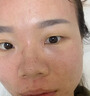 醫(yī)用冷敷貼面膜械字號醫(yī)美術后消炎美白補水曬后修復收縮毛孔祛痘淡化痘印生長因子重組三型人源膠原蛋白敷料 曬單實拍圖
