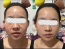 三型膠原蛋白不回落面部填充改善太陽(yáng)穴法令紋淚溝臉頰美院同款 曬單實(shí)拍圖