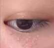 去除眼周白色顆粒脂肪粒去膏油脂粒眼睛脂肪粒汗管瘤小丘疹眼霜L 買二送一 曬單實拍圖