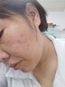 阿達帕林凝膠改得善毛孔粗大醫用祛的痘消炎痤瘡硬疙瘩專(zhuān)用藥痘痘粉刺痘印治療粉刺膿包皮膚用藥（視覺(jué)特效） 3盒裝【毛孔粗大可用】皮膚用藥 非處方藥 曬單實(shí)拍圖