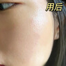 維特絲祛痘藥膏50g壬二酸水楊酸去痘痘和收毛孔閉口粉刺男女精華 曬單實拍圖