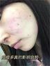 維特絲壬二酸祛痘藥膏去痘痘粉刺閉口收毛孔男女煙酰胺水楊酸青少年凝膠 曬單實拍圖