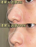 SKISGEM德國(guó)進(jìn)口去黑頭鼻貼導(dǎo)出液粉刺閉口收縮毛孔深層清潔三件套裝男女 【1盒裝】挑戰(zhàn)1次清空黑頭 曬單實(shí)拍圖