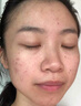維特絲壬二酸祛痘藥膏去痘痘粉刺閉口收毛孔男女煙酰胺水楊酸青少年凝膠 曬單實拍圖