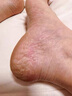 日本進口腳氣藥膏腳長小水泡足癢爛腳丫脫皮臭味大祛根癬腳上真菌 1盒裝*/【體驗裝】日本進口配方 曬單實拍圖