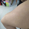 優(yōu)立特手臂毛囊炎專用噴霧劑胳膊上長小疙瘩小紅點雞皮膚毛周囊角化癥BC 2盒【優(yōu)惠裝】第二盒半價 曬單實拍圖