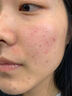 維特絲祛痘藥膏50g壬二酸水楊酸去痘痘和收毛孔閉口粉刺男女精華 曬單實拍圖