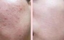 王老吉 清熱暗瘡片 中藥內(nèi)調(diào)去痘痘 治療痤瘡去粉刺清熱解毒口服 5盒*24片【距惠裝 低至49元/盒】 曬單實(shí)拍圖