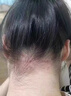 進(jìn)口男女士洗發(fā)水除螨祛痘毛囊炎去屑止癢控油蓬松洗洗頭發(fā)露膏液 除螨祛痘洗發(fā)水1瓶500ml 曬單實(shí)拍圖