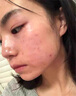 傾齡硫磺洗面奶祛痘除螨控油清潔痘痘黑頭收縮毛孔男女士水楊酸潔面乳 5支裝【硫磺凈顏洗面奶】 曬單實(shí)拍圖