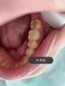 牙齒修復(fù)凝膠補(bǔ)牙洞神器材料永久自己在家樹脂醫(yī)用填充劑日本進(jìn)口 買3送2【蛀牙黑洞 齲齒】包治好 曬單實(shí)拍圖